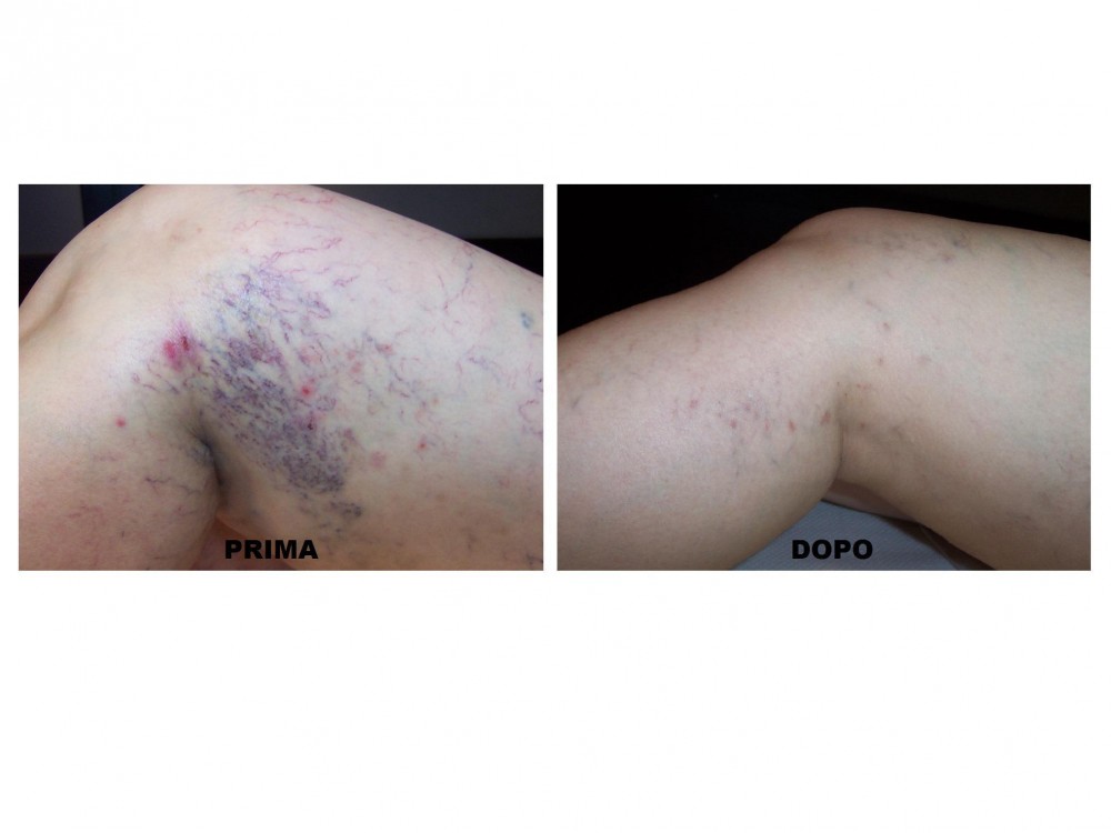 Foto capillari interno ginocchia - MEDI CLINIC LUXURY
