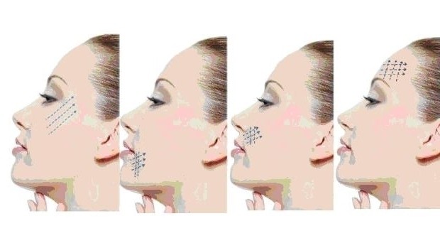 LA BIOSTIMOLAZIONE CON I FILI IN PDO - MEDI CLINIC LUXURY