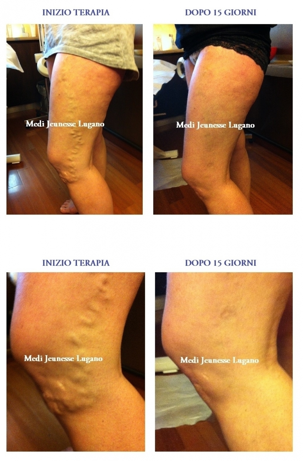 foto varici 1 - MEDI CLINIC LUXURY