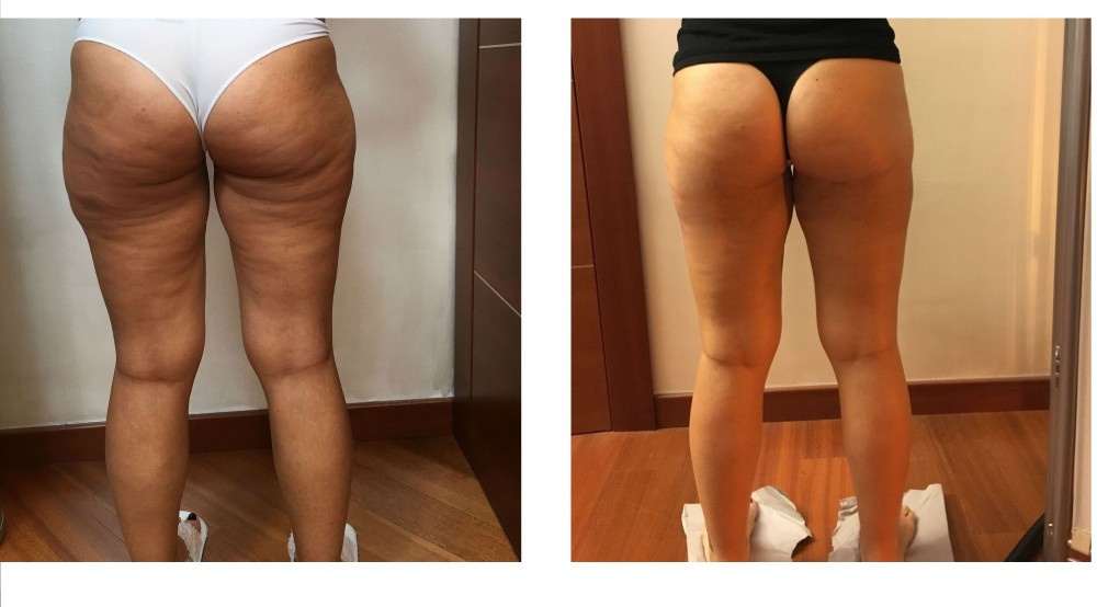 Foto Medilipo cosce - MEDI CLINIC LUXURY