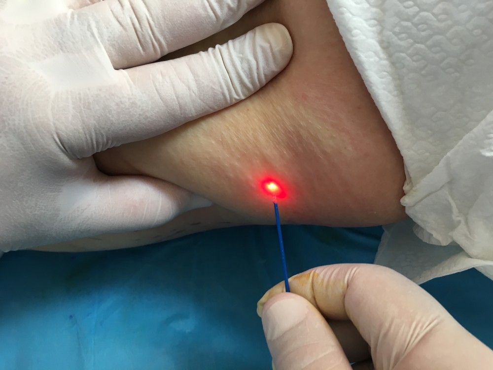 LIPOEMULSIONE CUTANEA 3D - MEDI CLINIC LUXURY