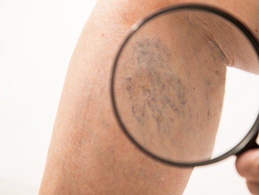 TERAPIA DEI CAPILLARI - MEDI CLINIC LUXURY