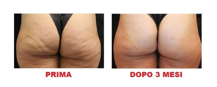 I RISULTATI DI CELLFINA - MEDI CLINIC LUXURY