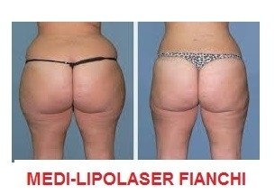 Foto medilipo fianchi - MEDI CLINIC LUXURY