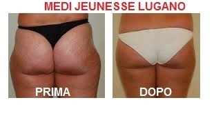 Foto medilipo culotte de cheval - MEDI CLINIC LUXURY