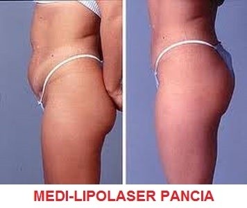 Foto medilipo pancia - MEDI CLINIC LUXURY