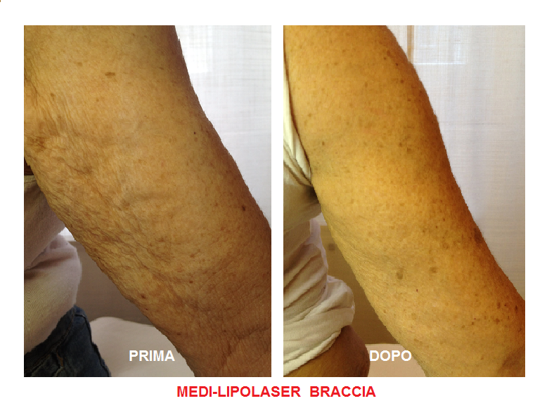Foto medilipo braccia - MEDI CLINIC LUXURY