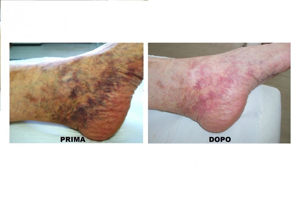 Foto capillari piede - MEDI CLINIC LUXURY