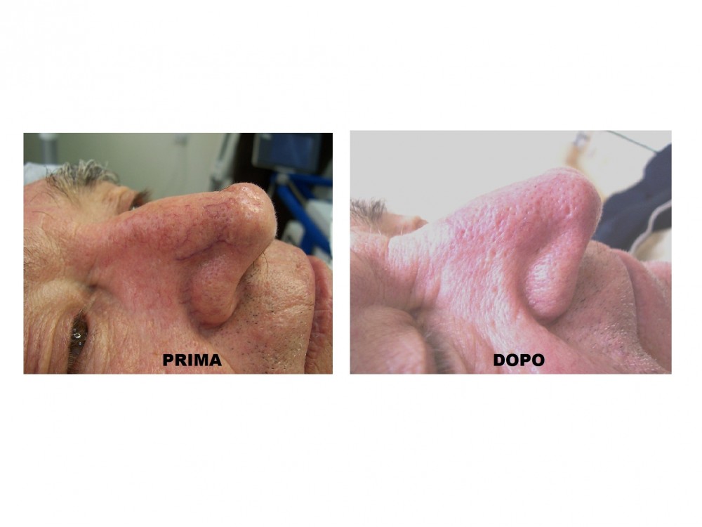 Foto capillare naso - MEDI CLINIC LUXURY