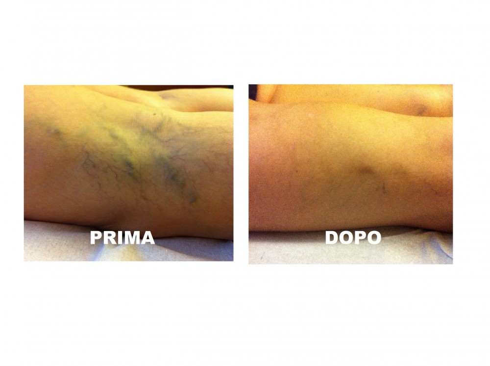 Foto capillari posteriore ginocchio - MEDI CLINIC LUXURY