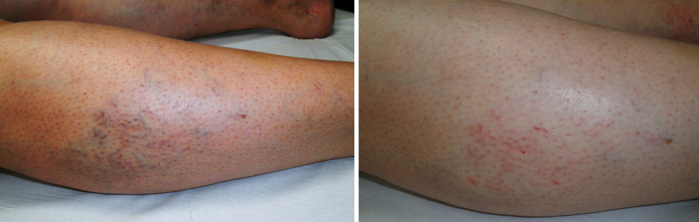 Foto capillari polpaccio - MEDI CLINIC LUXURY