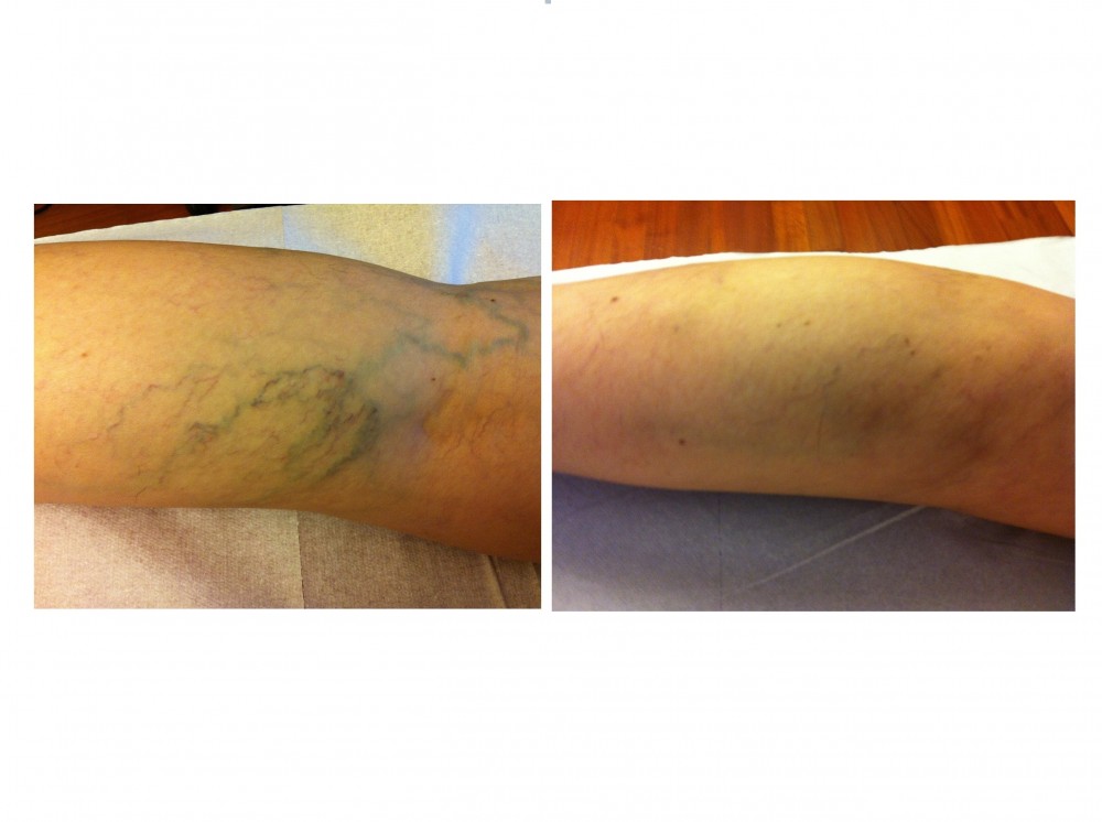 Foto varici 4 - MEDI CLINIC LUXURY