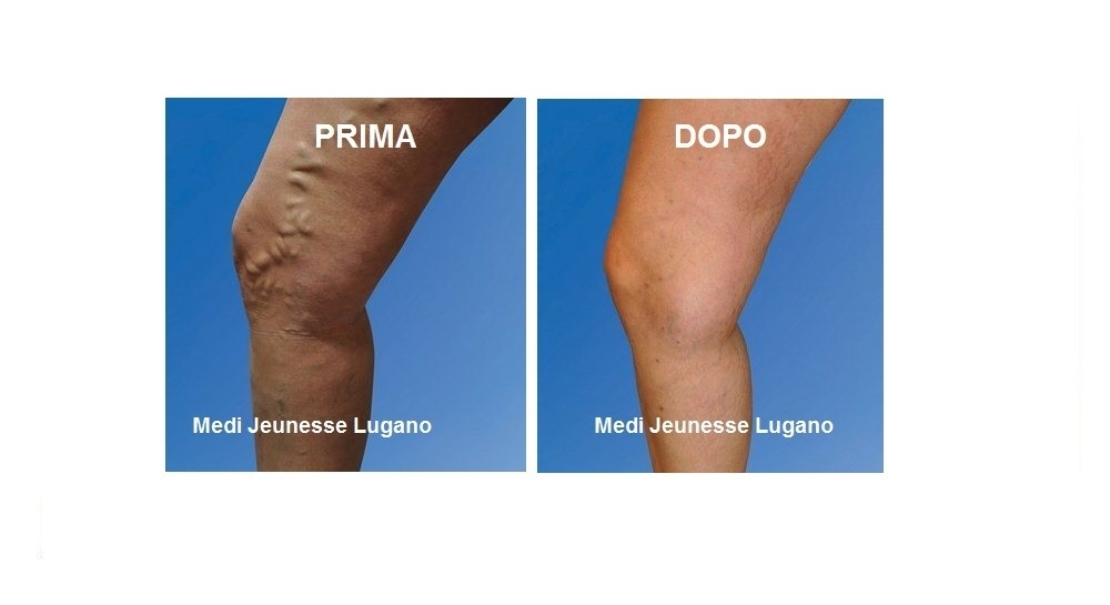 foto varici 2 - MEDI CLINIC LUXURY