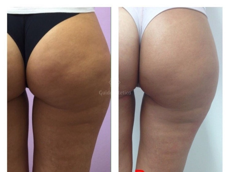 Foto Cellfina 1 - MEDI CLINIC LUXURY