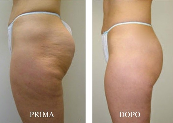 Foto Cellfina 5 - MEDI CLINIC LUXURY