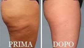 Foto Cellfina 4 - MEDI CLINIC LUXURY